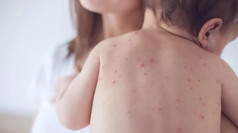 أسباب تقصف الأظافر والجدري المائي للأطفال