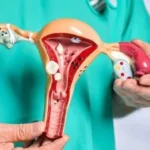 الأعراض المقلقة لسرطان المبيض وعلاقتها بالصحة العامة