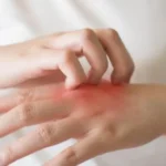 حب الشباب: العوامل الأكثر تأثيراً في ظهوره