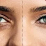 الهالات السوداء تحت العين: الأسباب وطرق العلاج
