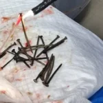 استخراج 100 مسمار من معدة مريض بمستشفى بني سويف الجامعي
