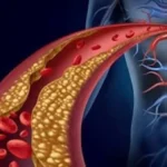 طرق طبيعية لعلاج انسداد الشرايين