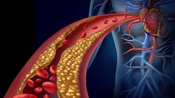 طرق طبيعية لعلاج انسداد الشرايين