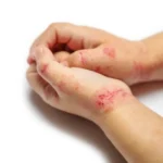 طرق طبيعية وفعالة لعلاج الأكزيما
