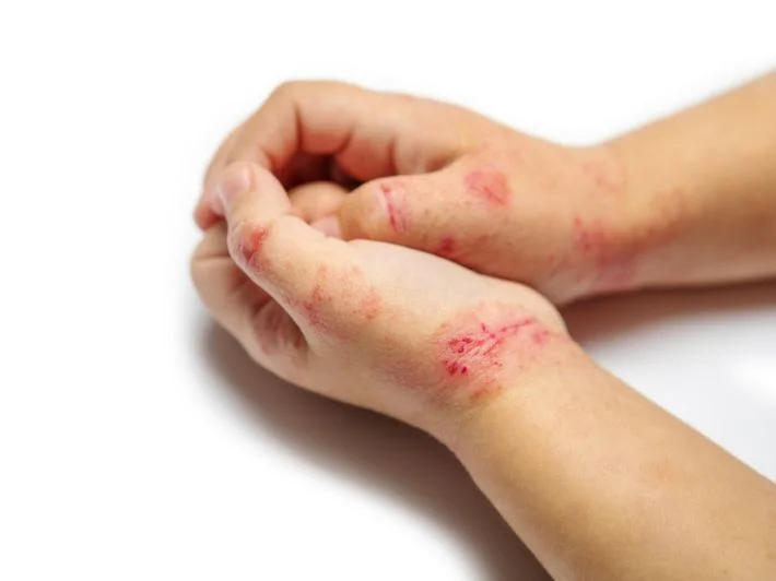 طرق طبيعية وفعالة لعلاج الأكزيما