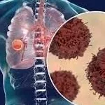 علامات سرطان الرئة وكيفية اكتشافه مبكرًا