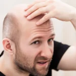 أسباب الصلع عند الرجال
