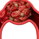 خطر الجلطات في الصيف: الفئات الأكثر عرضة
